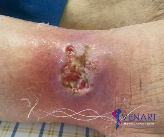 Ulceras Y Heridas Ags