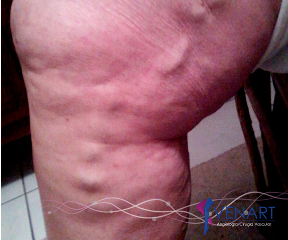 Varices Aguascalientes